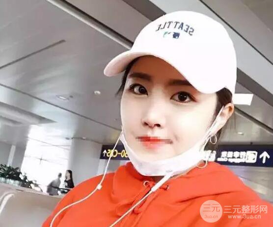 綜合隆鼻前后對比照片案例