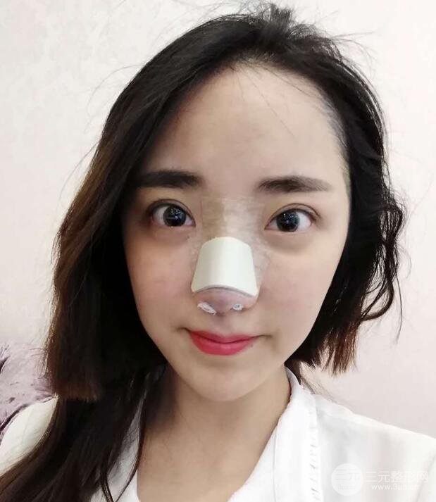 東莞寶格麗韋文奇隆鼻整形果圖分享，對比曝光