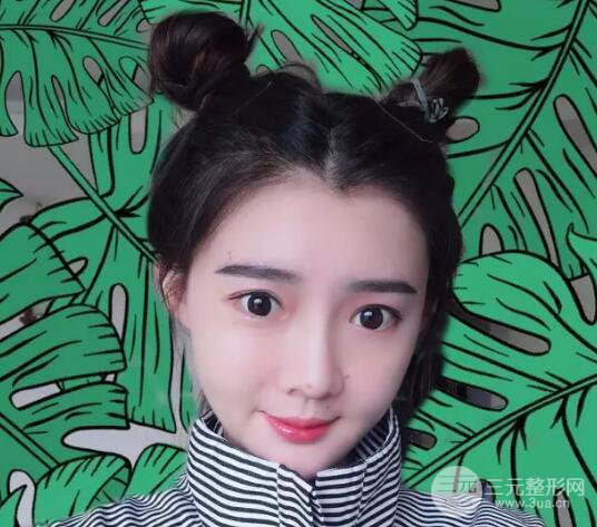 脂肪填充全臉恢復(fù)過程圖