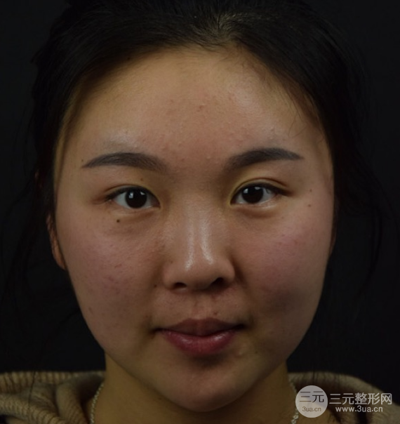 面部光纖溶脂三個(gè)月恢復(fù)記錄，妹子終于擺脫大臉盤子辣