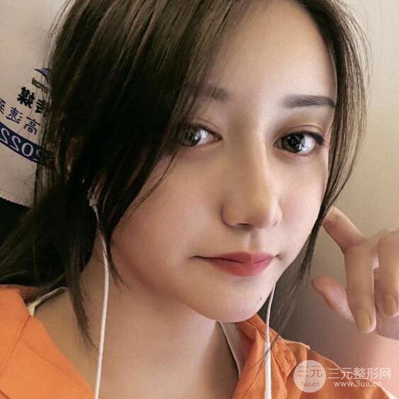 廣州名韓醫(yī)療美容卓敬錫“隆鼻整形+自體脂肪填充全臉”案例分享，整完有點像景甜