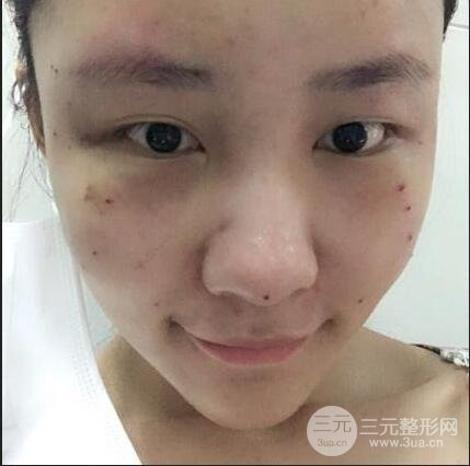 蘇州芘麗芙華美甘月圓自體脂肪填充全臉恢復(fù)記錄