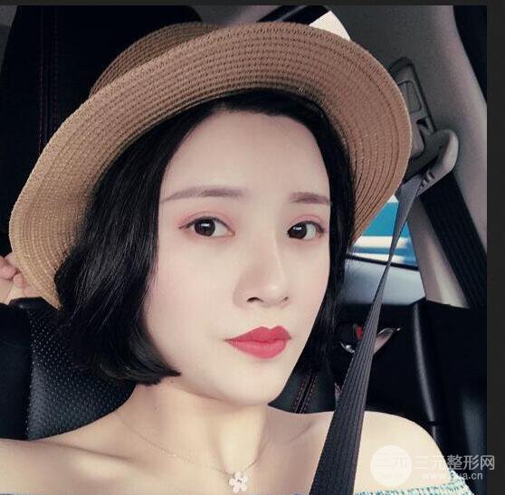 銀川崔大夫博士麗朱杰自體脂肪豐面頰恢復(fù)記錄附對(duì)比圖片