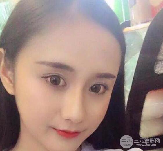 三亞三仁醫(yī)療美容于德印全切雙眼皮+開(kāi)眼角一個(gè)月恢復(fù)圖來(lái)辣