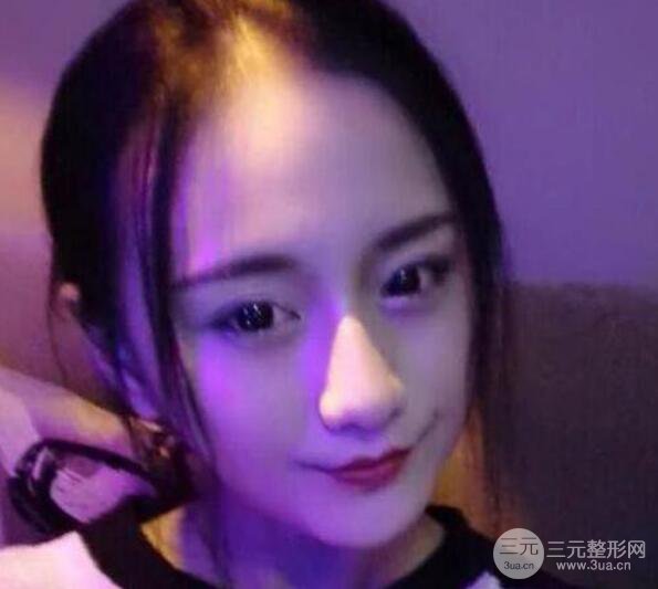 三亞三仁醫(yī)療美容于德印全切雙眼皮+開(kāi)眼角一個(gè)月恢復(fù)圖來(lái)辣