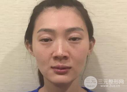 脂肪填充全臉恢復(fù)過程圖