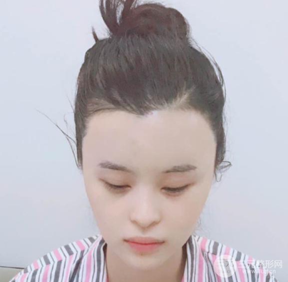 自體脂肪填充一個月真實恢復圖片，恢復后連閨蜜都驚艷辣