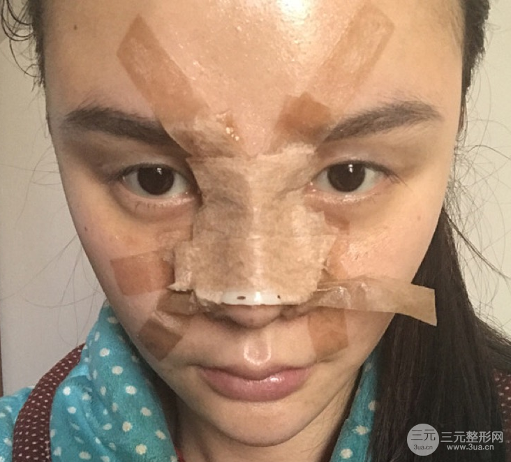 隆鼻整形三個(gè)月記錄，恢復(fù)后立體度不輸外國(guó)人