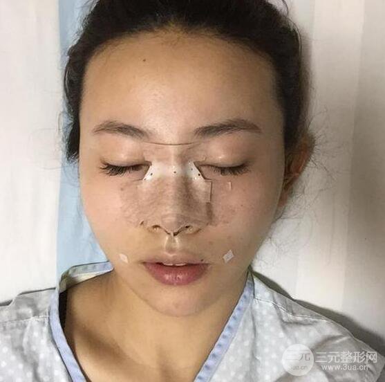 珠海陸達(dá)彭劍隆鼻整形術(shù)前術(shù)后對(duì)比