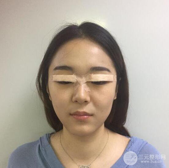 銀川西京整形醫(yī)院胡守舵【雙眼皮多項(xiàng)整形】全切雙眼皮真人案例