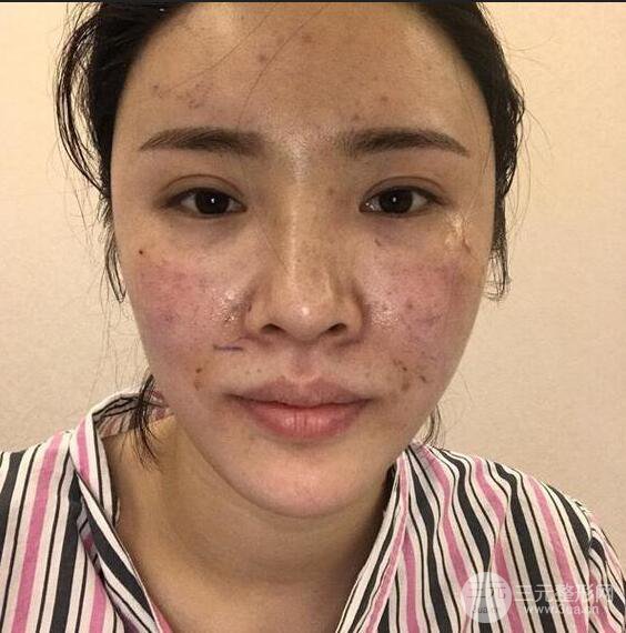 銀川崔大夫博士麗朱杰自體脂肪豐面頰恢復(fù)記錄附對(duì)比圖片