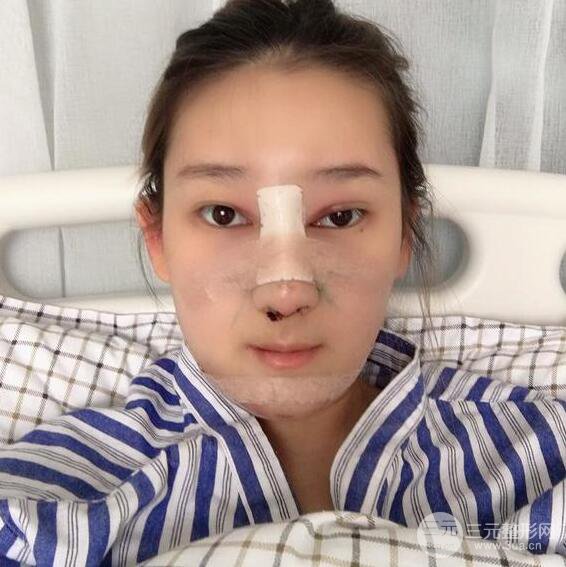 三亞三仁于德印肋軟骨隆鼻+硅膠墊下巴恢復(fù)對(duì)比圖