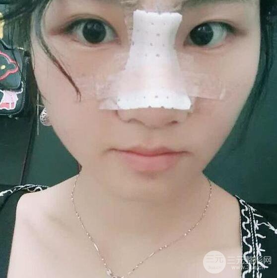 泉州億星醫(yī)療美容閔英俊膨體隆鼻果展示