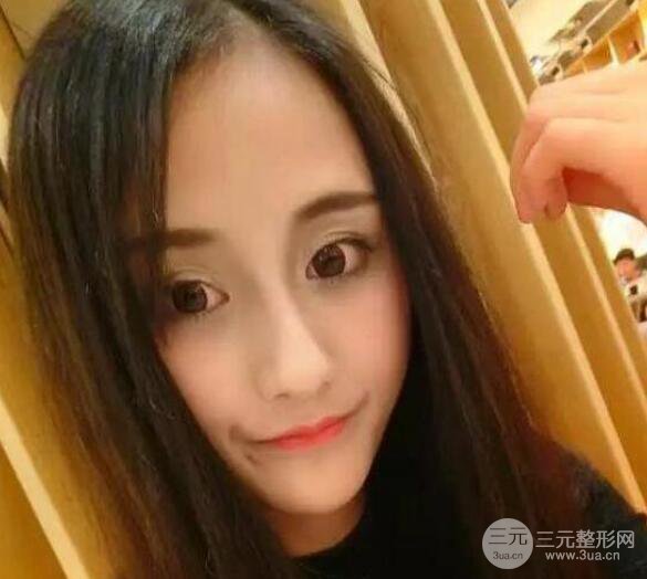 三亞三仁醫(yī)療美容于德印全切雙眼皮+開(kāi)眼角一個(gè)月恢復(fù)圖來(lái)辣