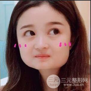 誰說臉大沒未來，下頜角整形后我輕松美出新高度