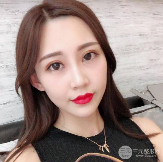 割雙眼皮兩個(gè)月是啥樣，妹子公開恢復(fù)記錄