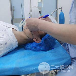 自體脂肪填充全臉恢復(fù)記錄