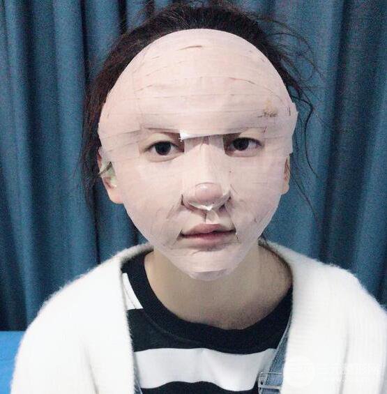 廣州名韓醫(yī)療美容卓敬錫“隆鼻整形+自體脂肪填充全臉”案例分享，整完有點像景甜