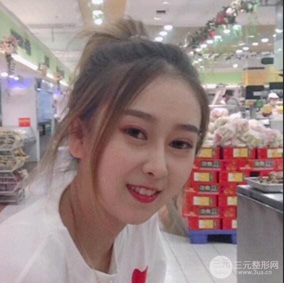 三亞三仁于德印肋軟骨隆鼻+硅膠墊下巴恢復(fù)對(duì)比圖