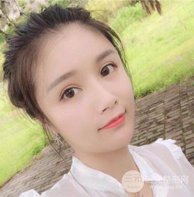 辣媽做了自體脂肪填充全臉，對比圖分享