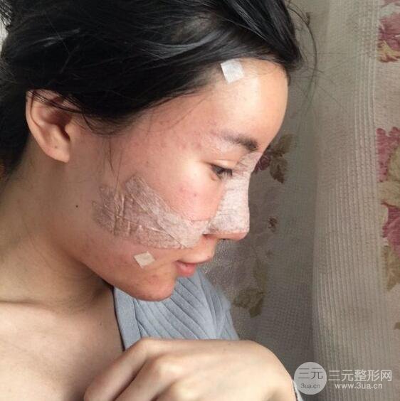 自體脂肪面部填充果對(duì)比圖