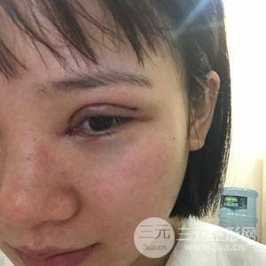 全切雙眼皮半個(gè)月恢復(fù)全記錄