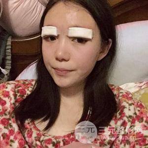 切開雙眼皮+上瞼下垂矯正術(shù)前術(shù)后果對比圖