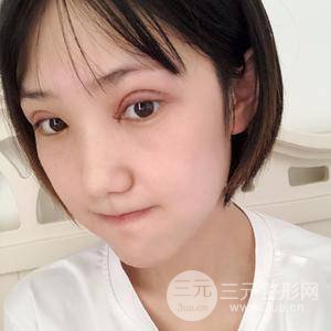 雙眼皮三個月果恢復(fù)圖