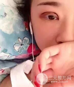 切開雙眼皮15天果圖