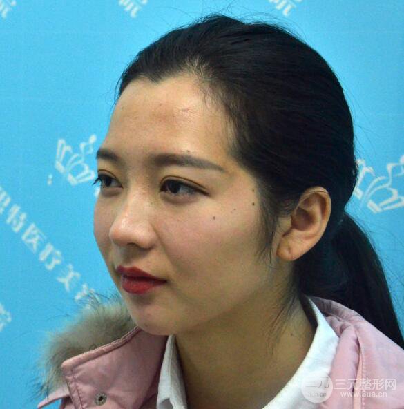 長(zhǎng)得太著急是怎樣一種體驗(yàn)？妹子血淚分享自體脂肪填充詳細(xì)部年輕化經(jīng)驗(yàn)