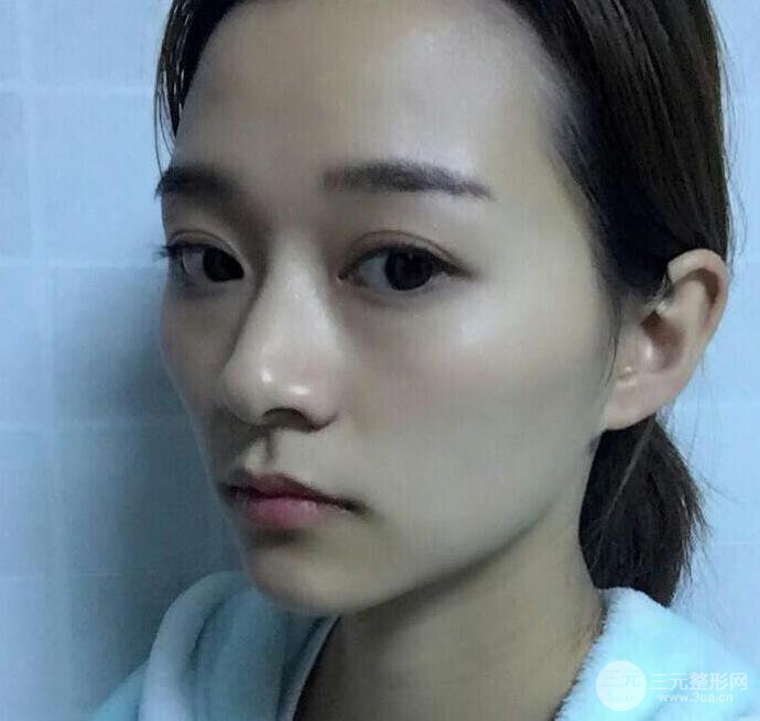 自體脂肪全臉填充三個月恢復圖，真實案例分享