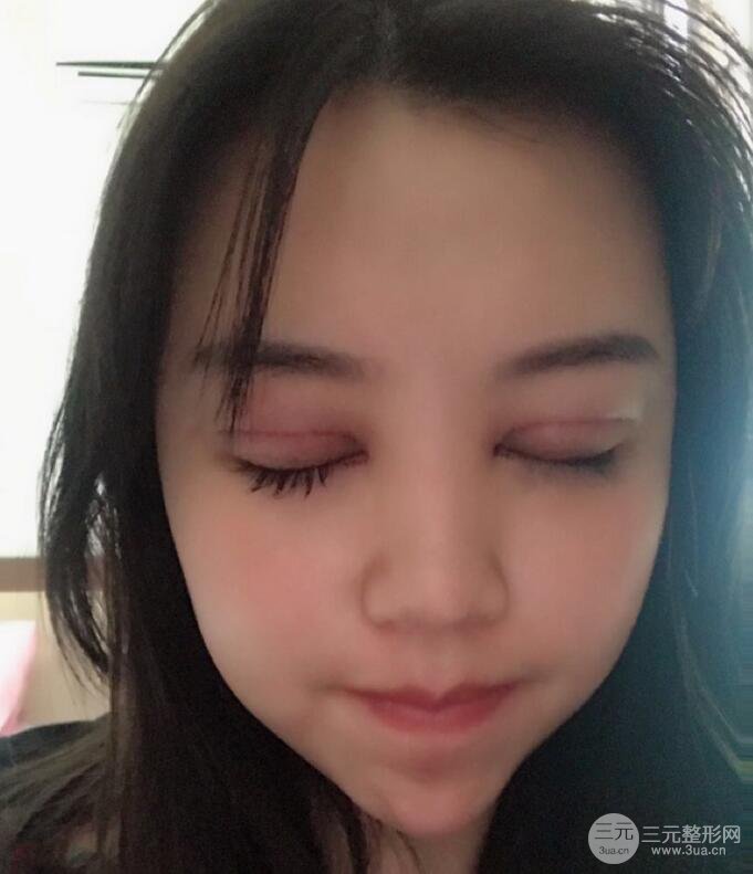蘇州芘麗芙華美孫培靈全切雙眼皮真人恢復(fù)圖曝光