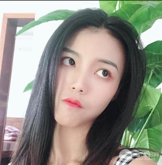 銀川崔大夫博士麗朱杰硅膠隆鼻恢復(fù)圖，輕松get精致臉