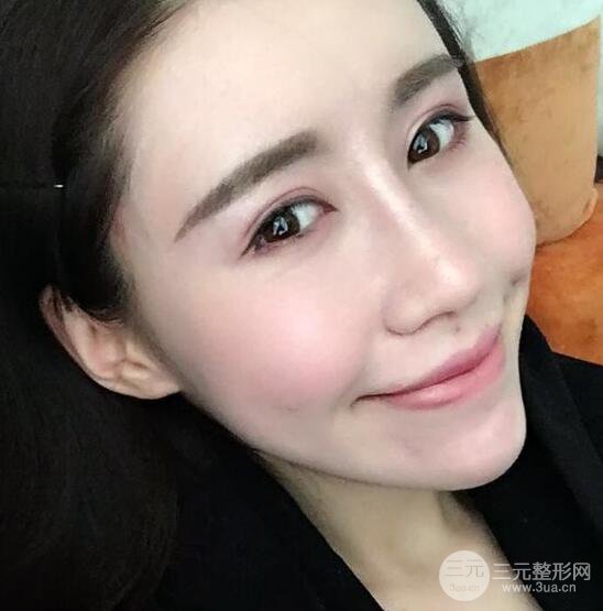 自體脂肪面部填充果對(duì)比圖