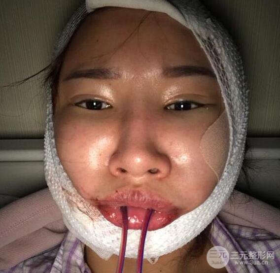去下頜角+顴骨內(nèi)推手術(shù)三個月記錄，看大臉妹如何逆襲