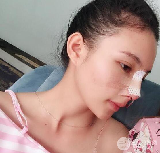 妹子做了隆鼻整形后竟變混血臉，來(lái)看看像baby還是娜扎