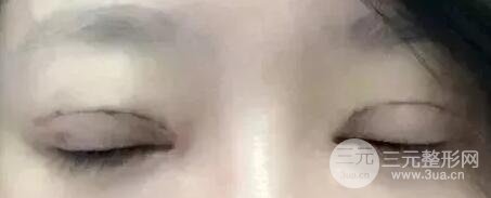 雙眼皮手術(shù)后恢復(fù)期記錄