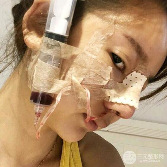 只是做了隆鼻整形改變居然辣么大，快來看看我的隆鼻整形恢復(fù)日記叭