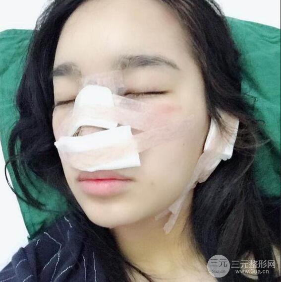 隆鼻整形術(shù)前術(shù)后對比照曝光，附經(jīng)驗分享及心得體會