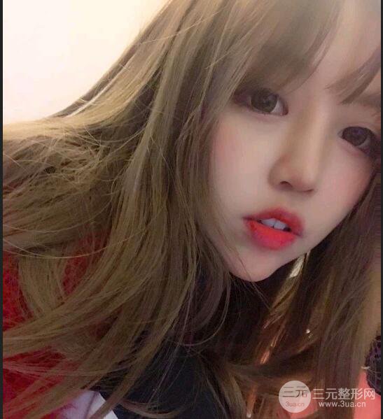 蘇州芘麗芙華美孫培靈全切雙眼皮真人恢復(fù)圖曝光