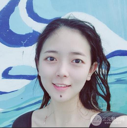 揚(yáng)州艾菲斯黃嬋雙眼皮多項(xiàng)整形整形果真人反饋