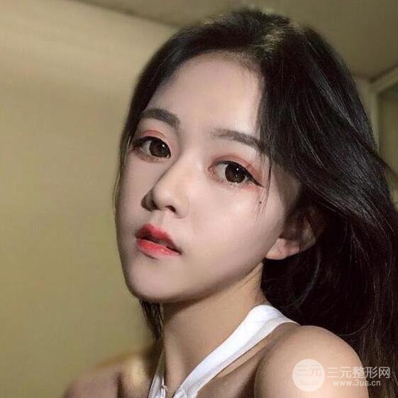 泉州億星醫(yī)療美容閔英俊切開(kāi)雙眼皮果對(duì)比