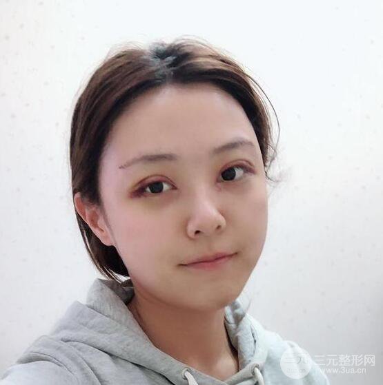 東莞君熠醫(yī)療美容李陵峰自體脂肪全臉填充恢復(fù)記錄