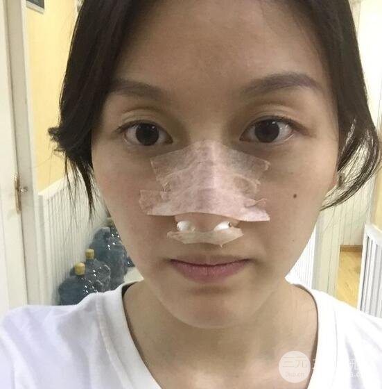 做了“埋埋蛋白線.提升+隆鼻整形”，恢復(fù)后老公說很沒有降低風(fēng)險(xiǎn)感