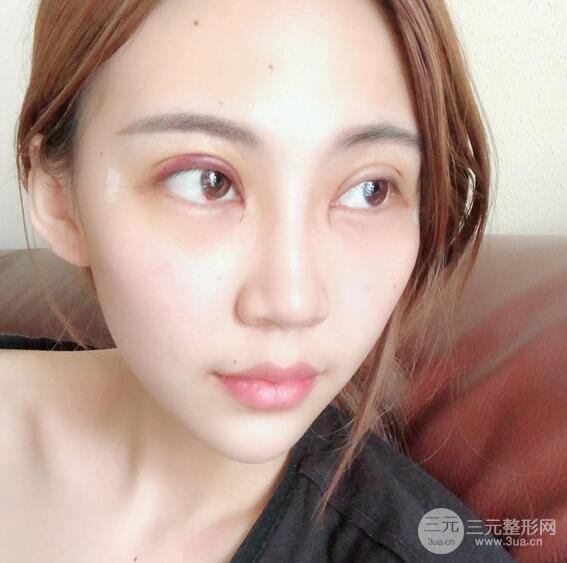 割雙眼皮兩個(gè)月是啥樣，妹子公開恢復(fù)記錄