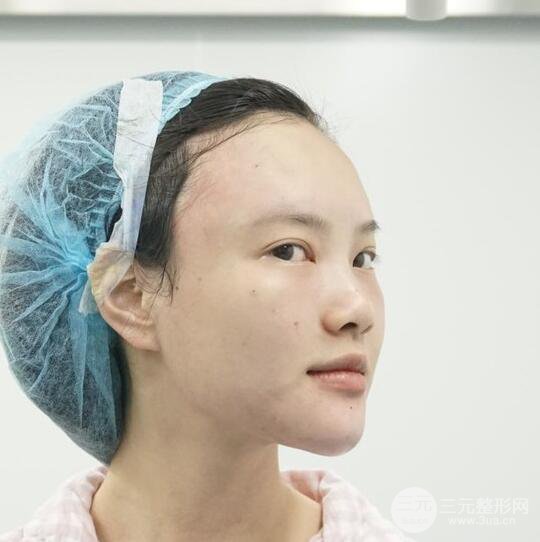 上海華美李健自體脂肪詳細(xì)部填充果圖，少女臉經(jīng)久不衰的秘密在這里