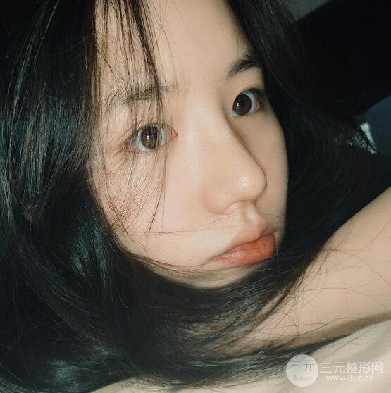 上海華美醫(yī)療美容李庭勛膨體隆鼻怎么樣？果對比圖