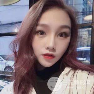 膨體大綜合隆鼻手術恢復過程圖附對比照