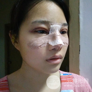 雙眼皮多項整形隆鼻整形一起做怎么樣？真人曝光果對比圖