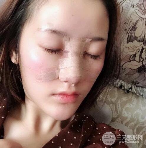 膨體隆鼻三十天恢復(fù)記錄，術(shù)前術(shù)后對(duì)比圖片曝光